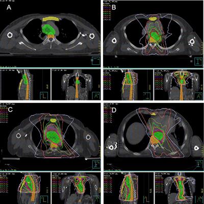 Severe radiation-induced lymphopenia during postoperative radiotherapy or chemoradiotherapy has poor prognosis in patients with stage IIB-III after radical esophagectomy: A post hoc analysis of a randomized controlled trial